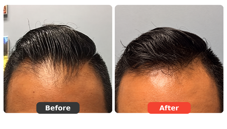 My Hairline Finally Looks More Defined