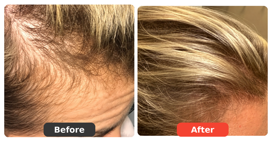I’m Finally Seeing New Coverage Around My Temples